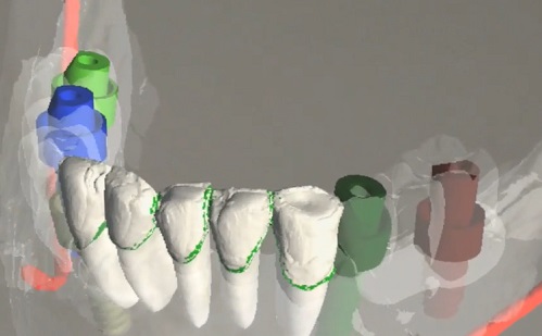 Hogyan használható a mesterséges intelligencia a fogászati implantátum tervezésében?