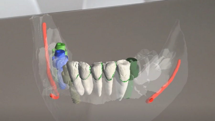 A mesterséges intelligencia a fogászati implantátum tervezésében is használható