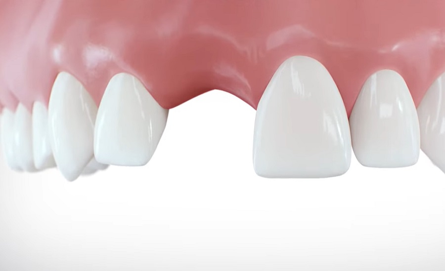 Fontos a fogászati implantátum - A foghiány számos bajjal jár