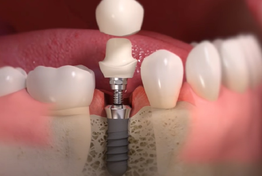 A fogászati implantátum a behelyezését követően gondos ápolást is igényel