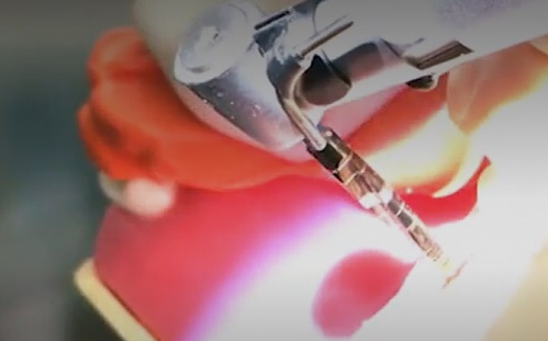 Fogászat - Robot adta vissza a páciens őrlőfogát