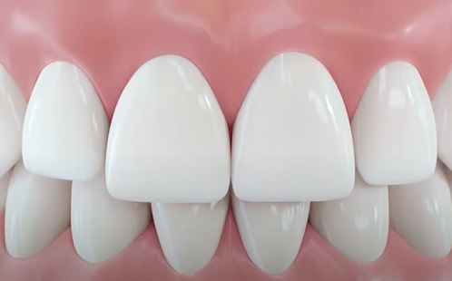 Miért kellenek robotok a fogimplantátum beültetéséhez? 