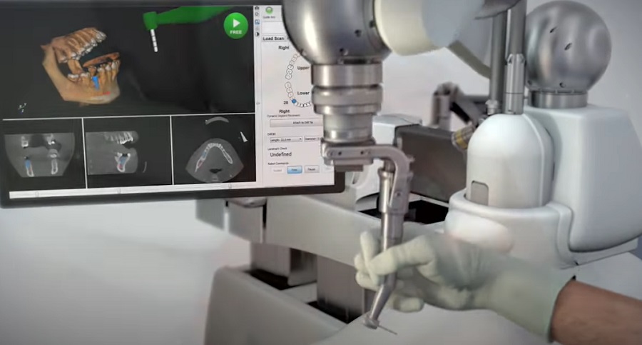 A robotfogorvos precízen beülteti a fogimplantátumot a páciens szájába