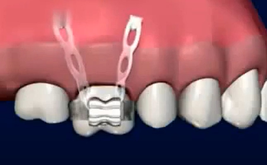 A mikroimplantátumok vagy mikrocsavarok kis titán rögzítőelemek