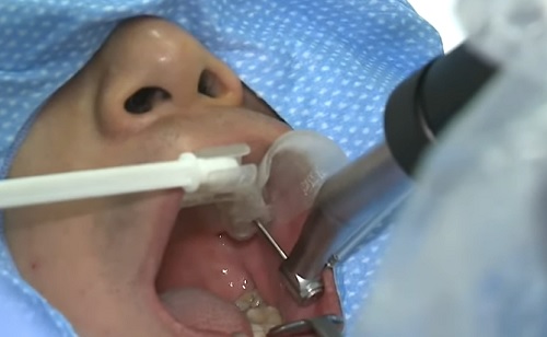 Digitális mosolytervezés – Miben segít igazán a fogászati robotika?