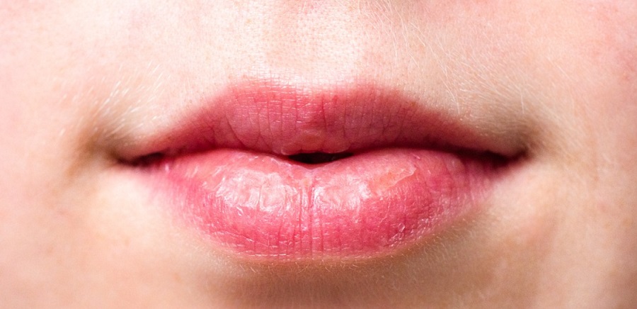 Kapszaicin cseppek kezelhetik az égő száj szindrómát