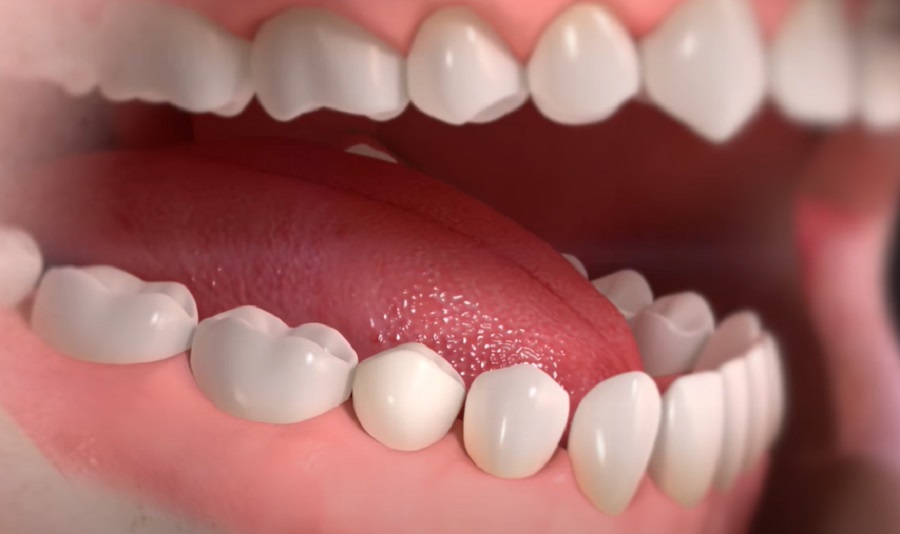 A fogászati implantátum visszaállítja a rágóerőt és a csontvesztést is megelőzi