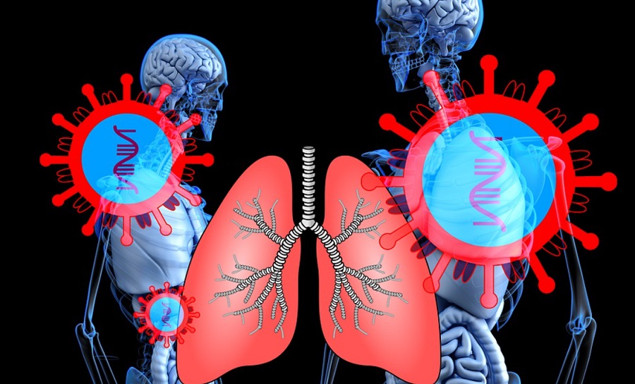 Koronavírust azonosít a tüdő képei alapján a mesterséges intelligencia