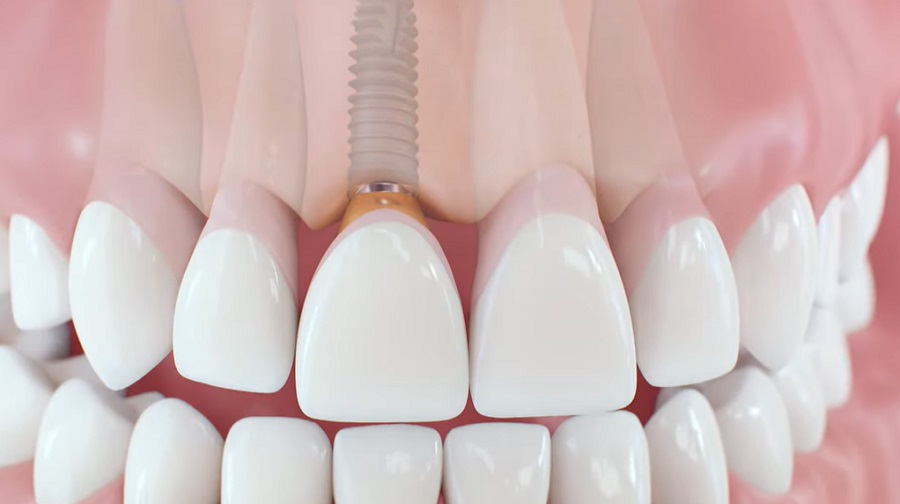 A fogászati implantátum számos okból jobb, mint a műfogsor