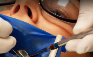 Gyökérkezelés – A precíziós fogászat gyorsabb felépülést, pontosabb kezelést kínál