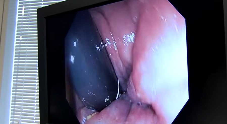 Alig l&aacute;that&oacute; polipokat sz&uacute;r ki a mesters&eacute;ges intelligencia a vastagb&eacute;lben 